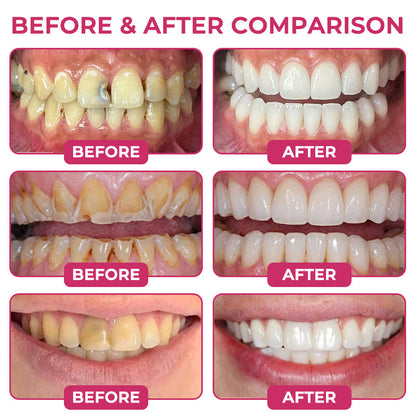 Suiiao® DenPerm Cavity-Repair Natural Enamel Filling Gel