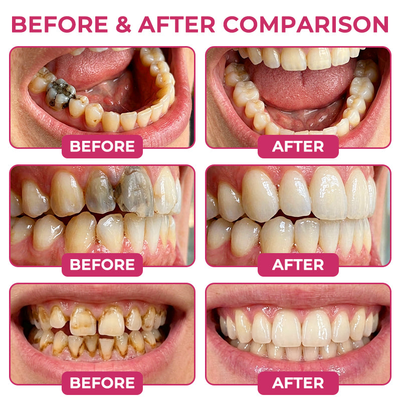 Suiiao® DenPerm Cavity-Repair Natural Enamel Filling Gel